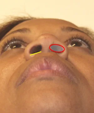 Close-up of a person's upturned face showing nostrils. Red circle on the right nostril and yellow line below the left nostril.