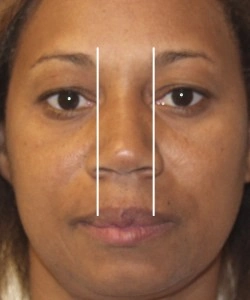 Close-up of a person's face with two vertical lines drawn from the eyebrows to the upper lip, highlighting facial symmetry.
