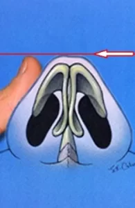An anatomical illustration of nasal septum deviation with a hand holding the diagram. A red arrow indicates the misalignment.