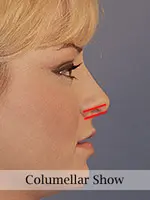 Side profile of a person highlighting the columellar show, with a red line indicating the nasal tip projection.