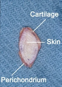 A cross-section of tissue labeled with "Cartilage," "Skin," and "Perichondrium" against a textured blue background.