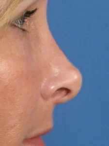 Side profile of a person's nose and eye against a blue background.