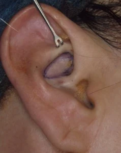 Close-up of an ear piercing procedure, showing a partially inserted hollow needle with a tool holding the ear in place.