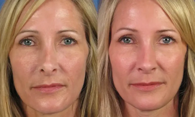 Side-by-side comparison of a woman's face before and after a cosmetic procedure, highlighting subtle changes in skin texture and tone.