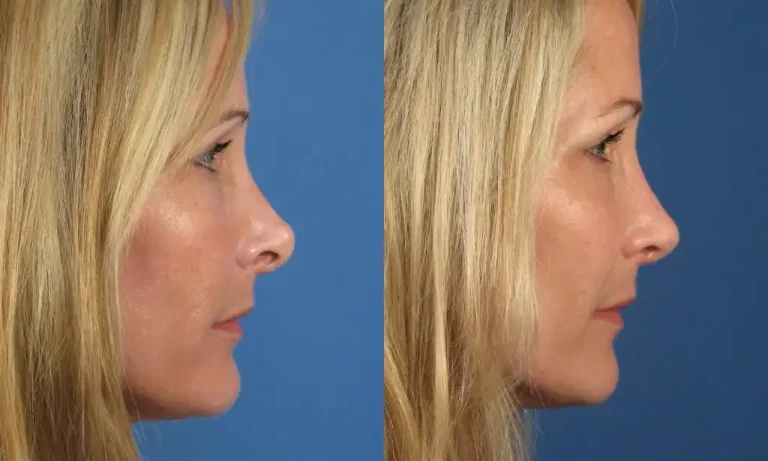 Side-by-side profile images of a person's face showing the nose before and after a cosmetic procedure, against a blue background.