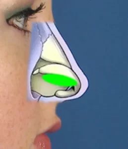 Side profile of a person’s face with a cutaway illustration showing nasal anatomy, highlighting the septum area in green.