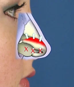 Side profile of a person's face with a diagram overlay showing nasal airflow and blockages.