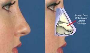 Side view of a person's nose alongside an anatomical illustration showing the lateral crus of the lower lateral cartilage labeled.