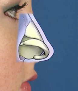 Side profile of a person's face with a transparent overlay showing nasal anatomy against a blue background.