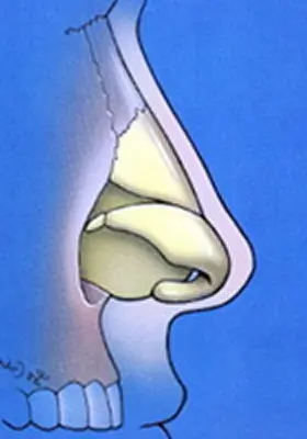 Illustration of a sagittal section of a human nose, showing nasal passages and anatomical structures against a blue background.