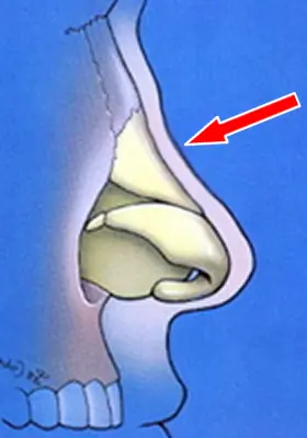 Illustration of a nasal cavity cross-section with an arrow pointing to the septum.