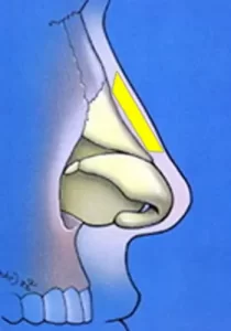 Diagram of a nasal structure in profile view with highlighted yellow area, showing internal anatomy against a blue background.
