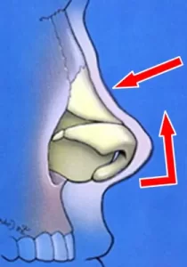 Illustration of a human nasal passage showing airflow direction with red arrows.