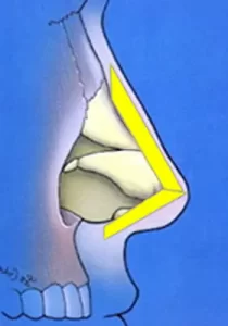 Illustration of a nose’s lateral side, showing internal structures with a yellow triangular outline highlighting a specific area.