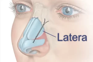 Illustration of a nasal implant placement in a human nose, labeled "Latera," showing the implant's position to support nasal structure.