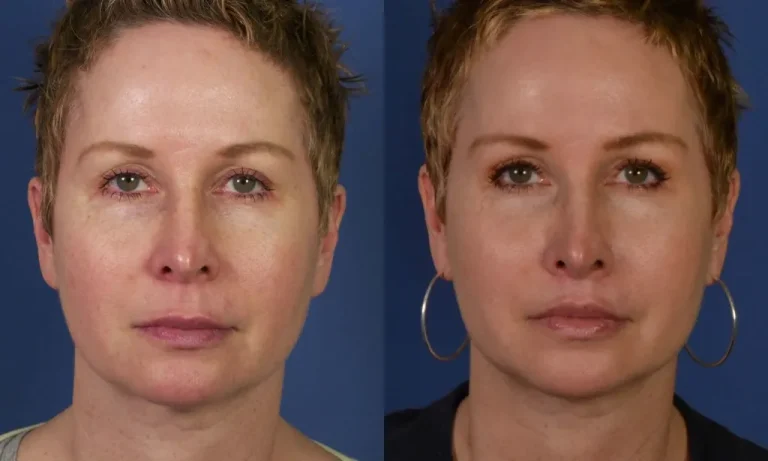 Side-by-side images of a person with short hair, before and after cosmetic enhancement, showing subtle changes in facial features and skin texture.