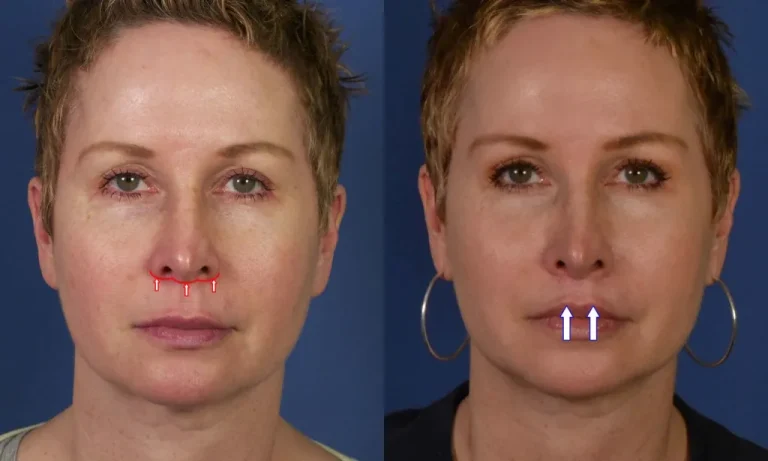 Side-by-side images of the same woman before and after a lip enhancement procedure, with arrows indicating changes in the upper lip area.