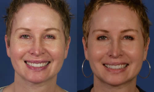 Close-up photos of a person smiling with short hair, showing a before-and-after comparison.