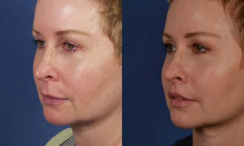 Two side-by-side images showing a woman's face before and after a cosmetic procedure, highlighting changes in skin texture and facial contour.