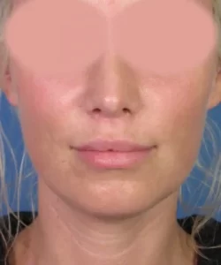 A close-up image of a person's face with blurred eyes, featuring light skin, closed lips, and light hair against a blue background.