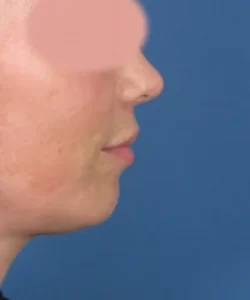 Side view of a person's face against a blue background, with the eyes obscured.