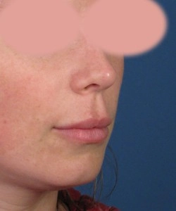 A close-up of a person's face, with eyes obscured. The focus is on the nose and mouth area, shown against a blue background.