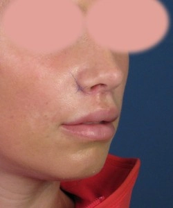 Person with a surgical scar near the upper lip, wearing a red collar, against a blue background.