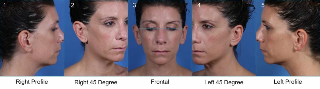 Front and side views of a person with a neutral expression are shown across five images, including right profile, right 45-degree, frontal, left 45-degree, and left profile perspectives.