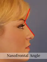 Profile view of a person's face with a red line indicating the nasofrontal angle.
