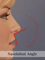 Profile view of a person's face with red lines indicating the nasolabial angle.