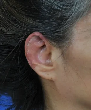A close-up of a person's ear showing dry skin and flaking areas on the earlobe and surrounding skin. Hair is visible, partially covering the ear.