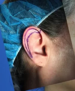 A person's ear with purple markings, likely indicating a surgical area. The individual is wearing a blue surgical cap.
