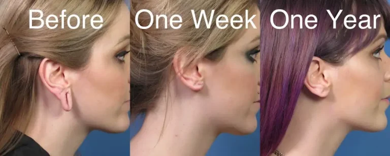 Three side profile images showing a woman's changing hair color and earlobe over time: before with blonde hair, one week later with blonde hair, and one year later with purple hair.