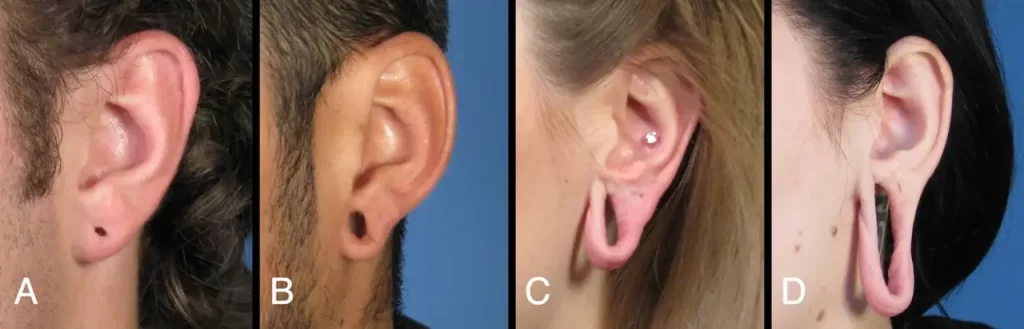 Four side-by-side images of ears with different modifications: A. small tunnel; B. larger tunnel; C. stud earring; D. significantly stretched earlobe.