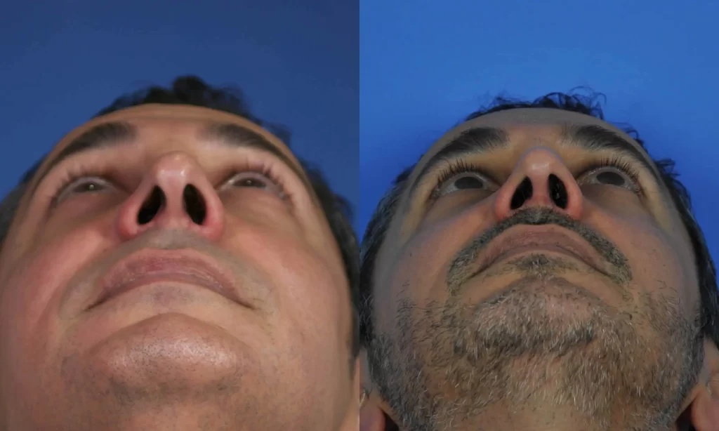 Side-by-side comparison of a man's face before and after a nose surgery, showing changes in nostril shape and skin texture under blue lighting.