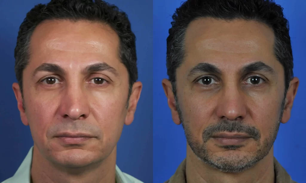 Side-by-side close-up photos of a man's face. The left shows a clean-shaven look, while the right shows a beard. Both have a blue background.