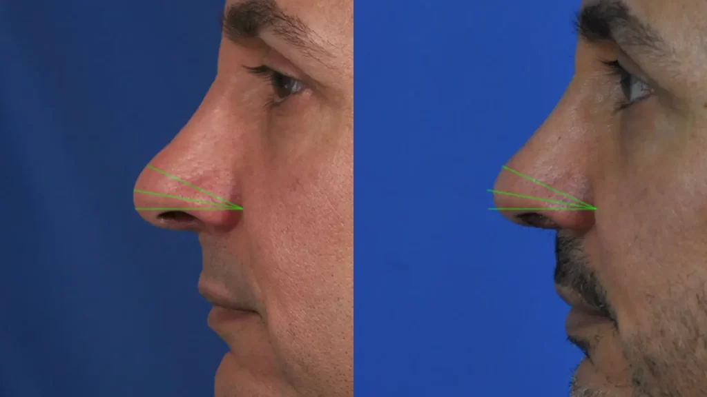 Side-by-side comparison of two profile images showing nose angle measurements with green lines on a blue background.