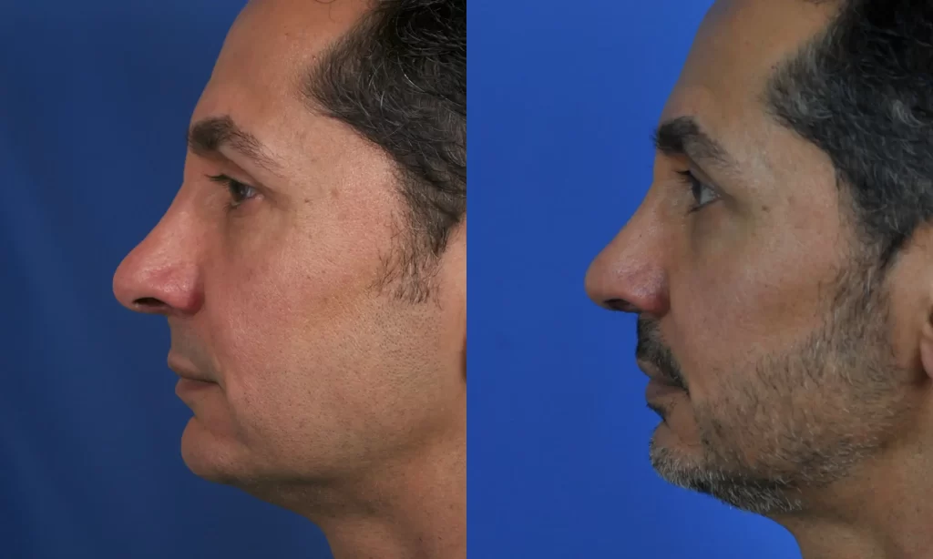 Side-by-side profile view of a man's face before and after rhinoplasty, showing a smoothened nose contour against a blue background.