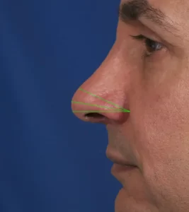 Side profile of a person's nose against a blue background, with green lines measuring angles on the nose.