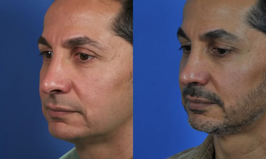 Side-by-side images of the same man before and after rhinoplasty, showing changes in nose shape and facial hair. Blue background.