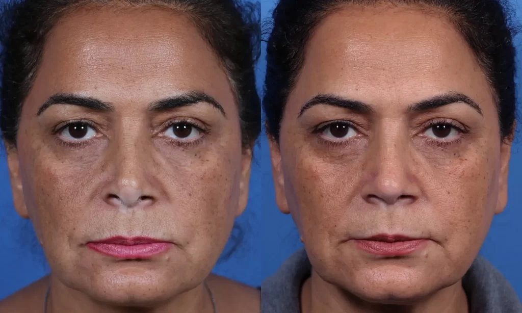 Before and after images of a woman's face showing subtle changes in skin texture and tone. Both images have a blue background.