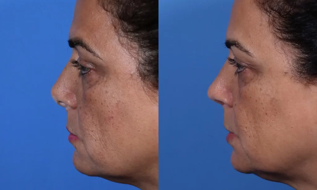 Side-by-side comparison of a woman's face before and after a cosmetic procedure, showing changes in skin texture and contour against a blue background.