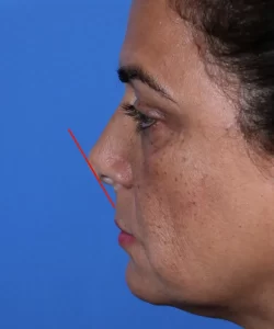 Profile of a person against a blue background, showing a red line angled away from the nose.