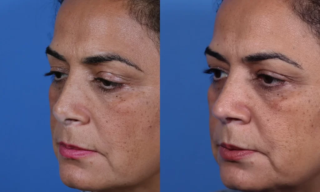 Before and after images of a woman's face, showing skin texture improvement from left to right. Blue background.