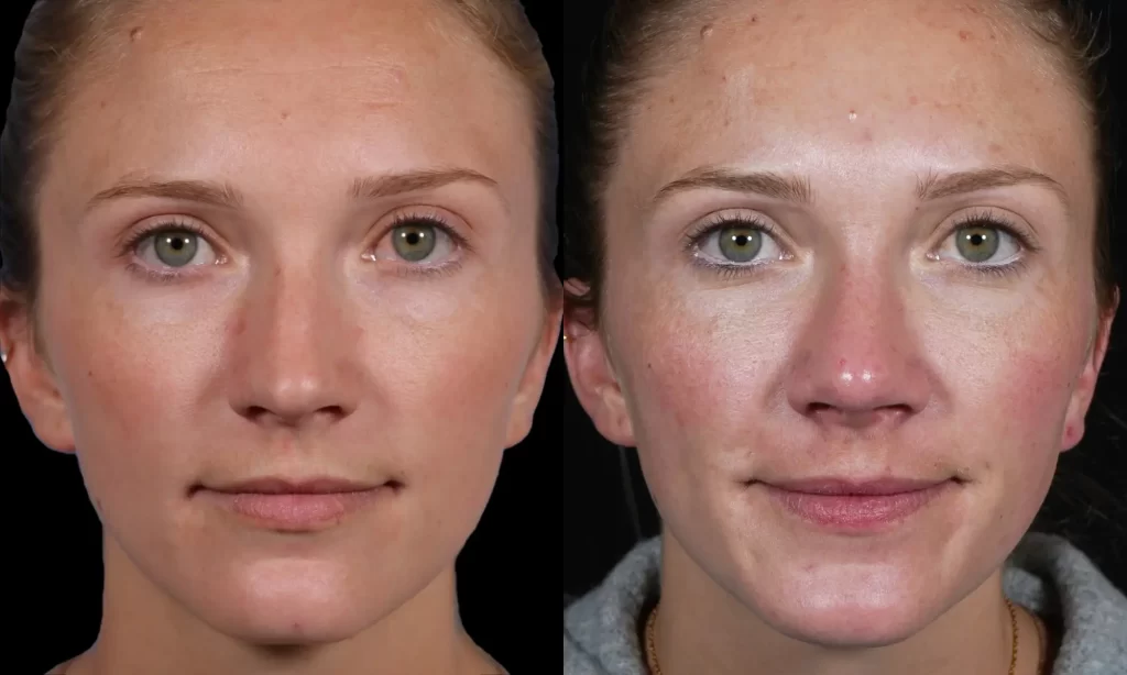 Two side-by-side images of the same woman. The left image shows a clearer complexion, while the right image shows more redness and blemishes on her face.
