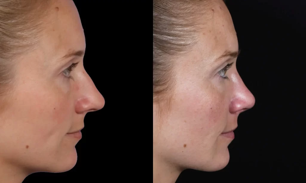 Profile view of a woman's face before and after a cosmetic procedure, showing a noticeable change in the nose's shape and contour against a black background.