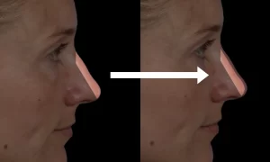 Side-by-side profile images showing a nose before and after a cosmetic procedure, with an arrow indicating the change.