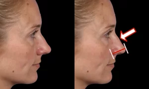 Side profile of a woman's face, with an edited version on the right showing an arrow pointing at the nose and markers indicating changes in nose shape.