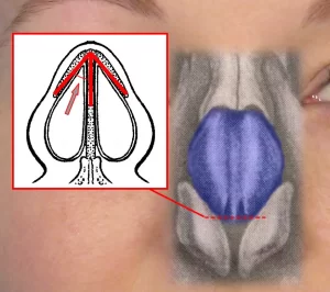 Diagram showing a nasal valve with an overlay highlighting the blue anatomy area and red arrows indicating airflow direction.