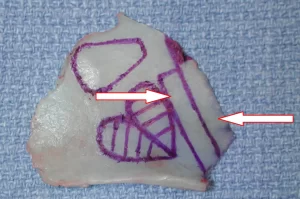 A bone fragment with abstract purple lines and two white arrows on a textured blue background.